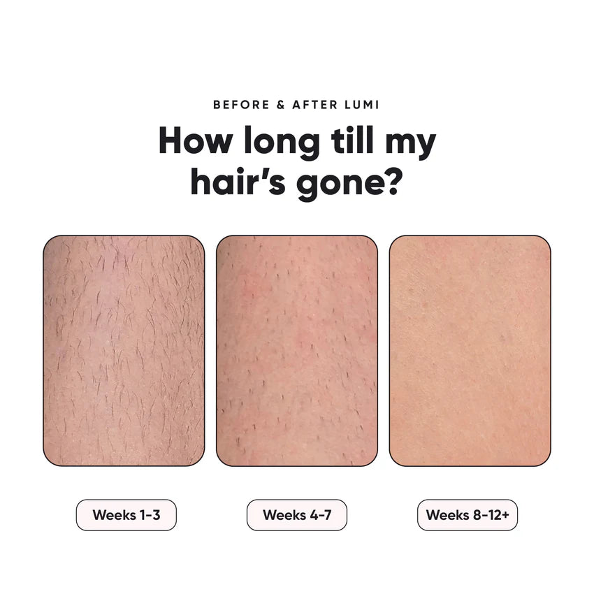 🌸Portable IPL Hair Removal laser – Face & Body